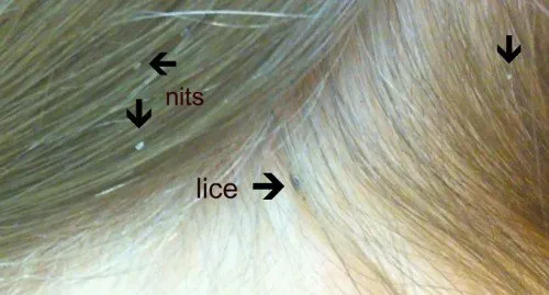 What Does Lice Look Like?